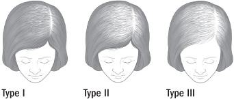 Illustration of the patterns of female hair loss
