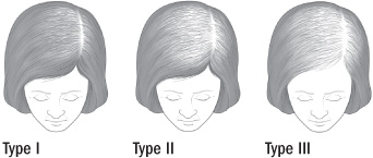 Treating female pattern hair loss - Harvard Health