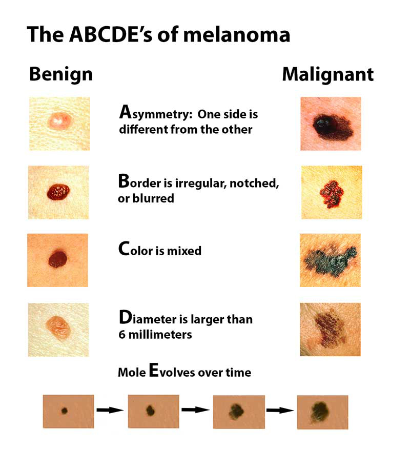 What causes melanoma cancer?