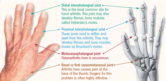 Relief For Hand Arthritis Harvard Health Relief For Hand Arthritis Harvard Health
