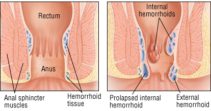 Bumps in anus cannot stool Medication women with facial hair