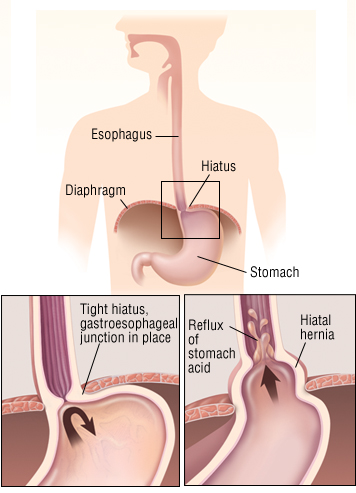 hiatal hernia harvard health how do hernias form