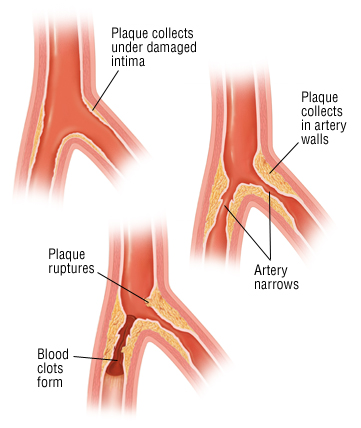 atherosclerosis harvard health how does plaque form