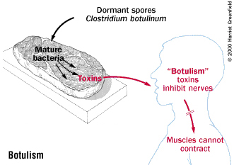 how does botulism cause paralysis