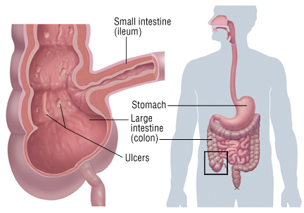 Lose weight ptosis picture 4