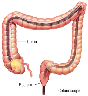 colonoscopy harvard health