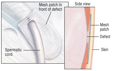 relations surgery hernia sexual post