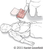 illustration showing use of public defibrillator