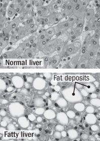 illustration comparing normal liver and liver with fatty deposits