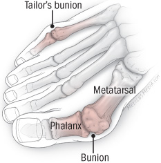 What is a tailor's bunion? - Harvard Health
