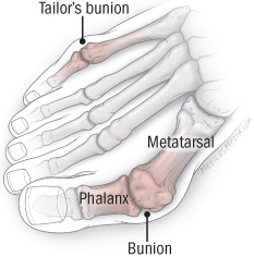 tailor's bunion insoles