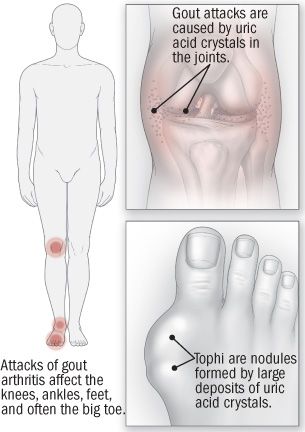 Can gout spread to other parts of the body?