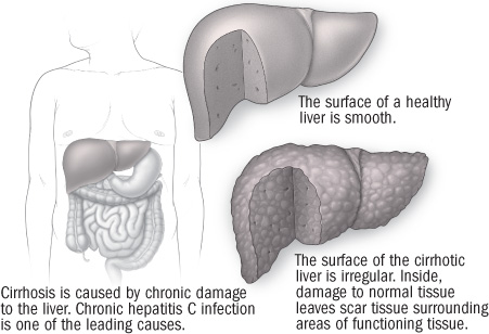 illustration of liver showing damage from cirrhosis