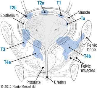 What are the symptoms of a tumor of the bladder?