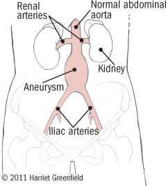 Abdominal Aortic Aneurysm Size Chart