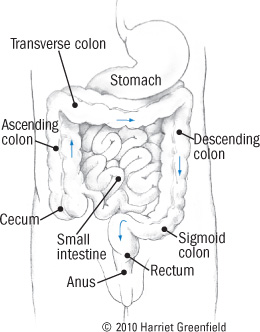 Diverticulitis Vs Diverticulosis Chart