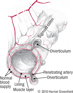 Diverticulitis Vs Diverticulosis Chart