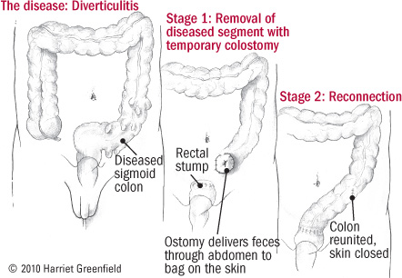 Diverticular disease of the colon - Harvard Health