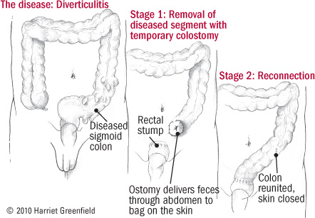 Diverticulitis Vs Diverticulosis Chart