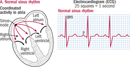 Sinus Rhythm Chart
