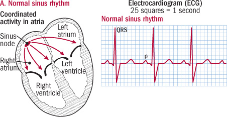 Afib Chart