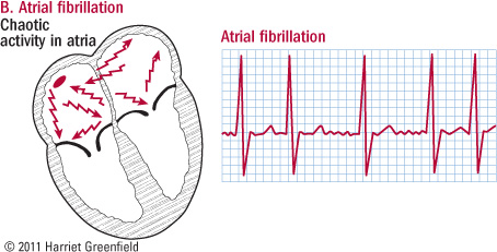 Afib Ekg Chart