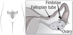 illustration of ovary and Fallopian tube