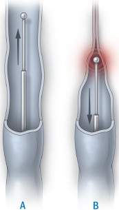 illustration of endovenous treatment using laser