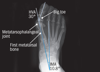 Bunions Callous