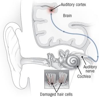 tinnitus ile ilgili görsel sonucu