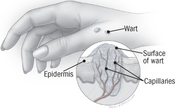 illustratie van de huid met close-up van de wrat