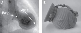 photographs of left ventricle with apical ballooning, and of the tako-tsubo which the ventricle resembles