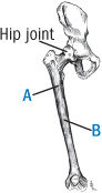 illustration of thighbone showing locations of fractures