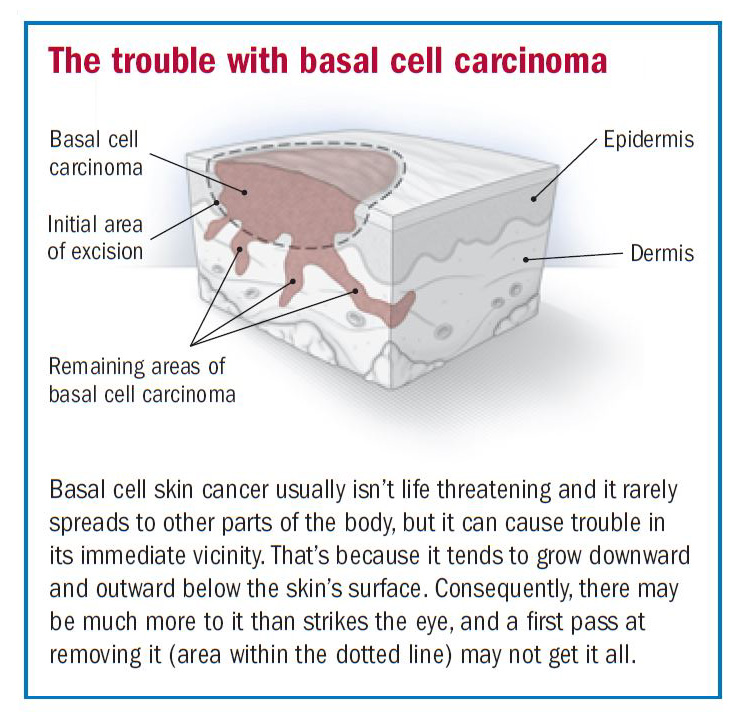 Basal Cell Carcinoma Overview Harvard Health