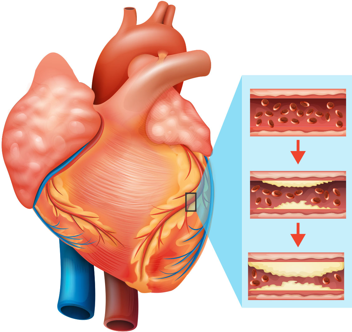 A closer look at heart disease risk - Harvard Health