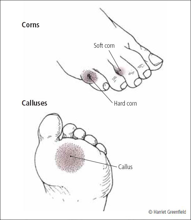 sharp pain in callus on foot
