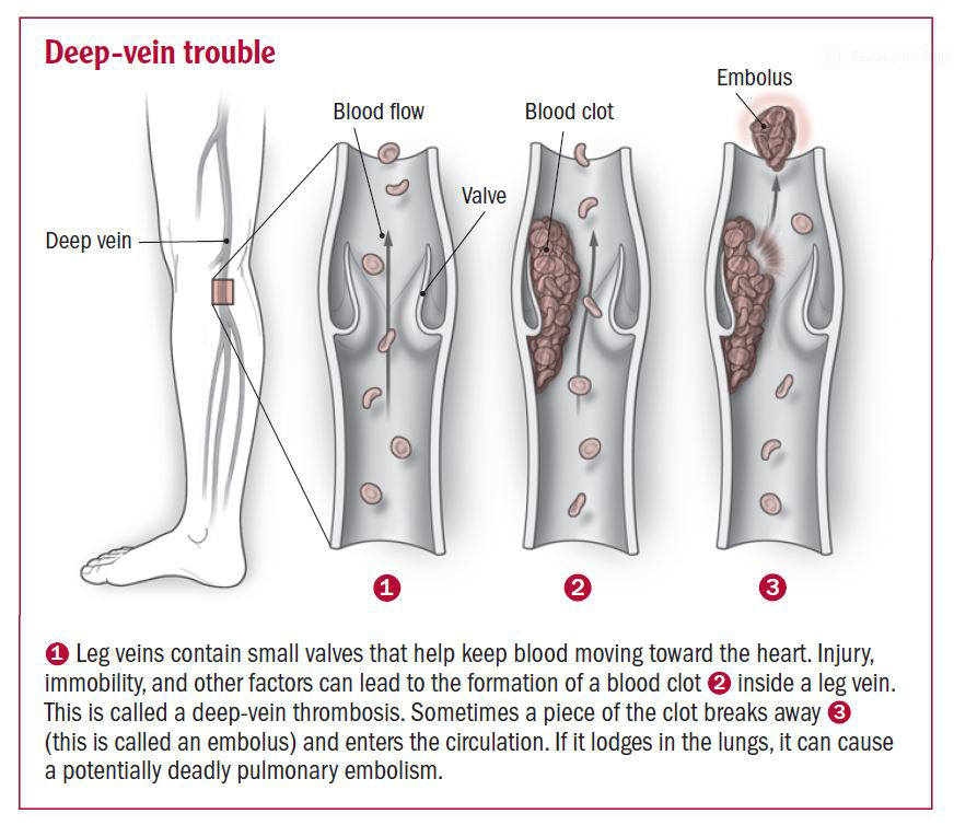 Diet Chart For Dvt Patients