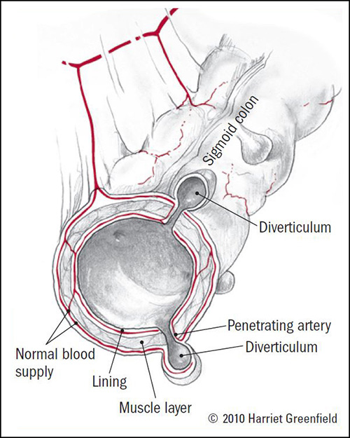 Featured image of post Symptoms Of Diverticulitis Flare Up : The symptoms of diverticulitis can include abdominal pain and tenderness, fever, chills, constipation or frequent symptoms.