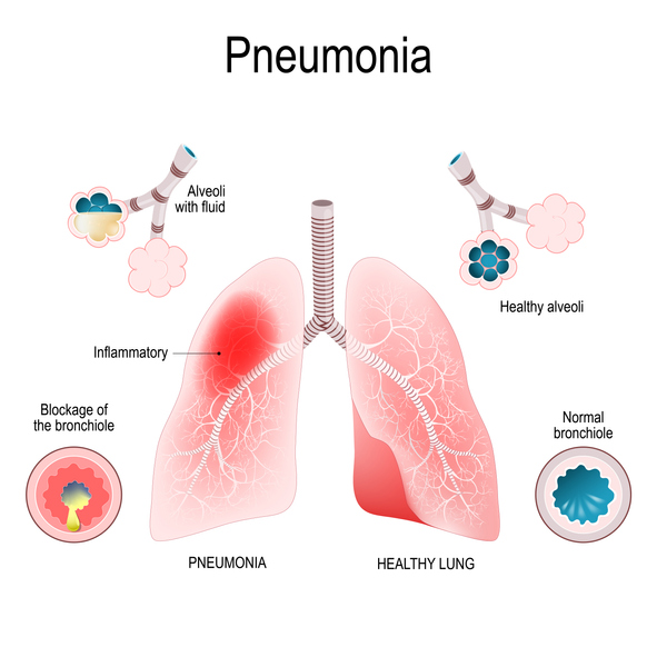 How To Tell If You Have Pneumonia Or Not