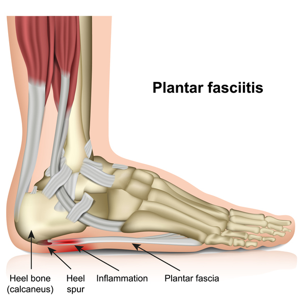 heel pain in the morning treatment