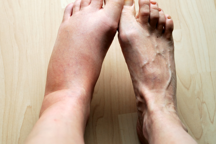 Concerns About Swollen Legs Harvard Health