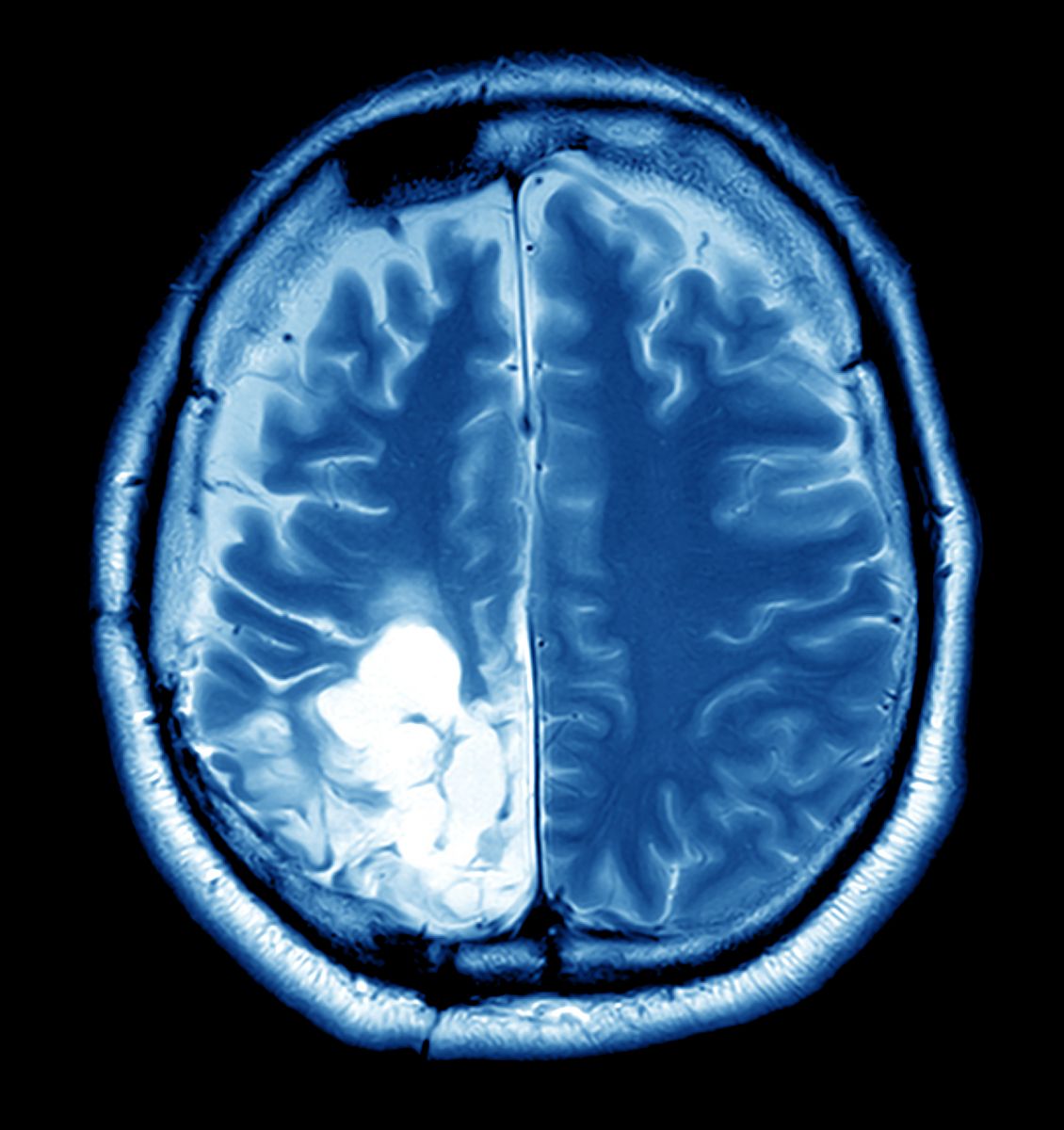 Benign Brain Tumor Size Chart