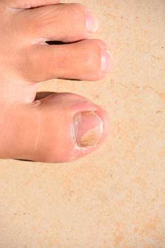 How To Kill Toenail Fungus In Shoes