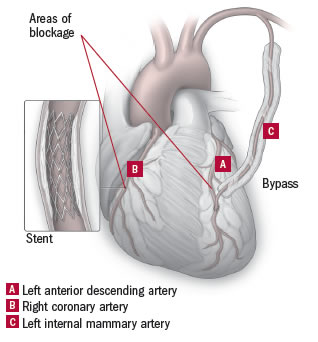 Bypass plus angioplasty: The best of both worlds? - Harvard Health Bypass plus angioplasty: The best of both worlds? - Harvard Health