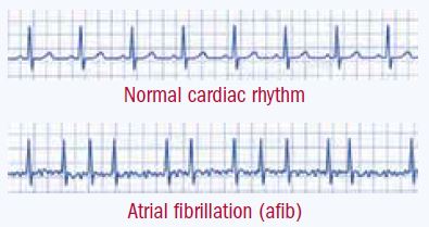 Afib Ekg Chart