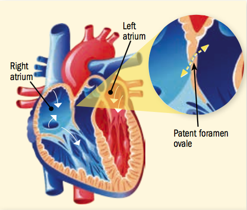 After a stroke with no clear cause, a heart repair may be ...