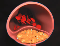 「Vascular cholesterol」の画像検索結果