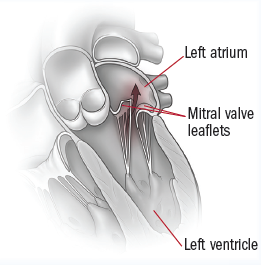 What are the symptoms of a leaky heart valve?