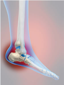 help for heel pain