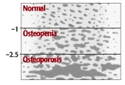 Normal; Osteopenia -1; Osteoporisis -2.5